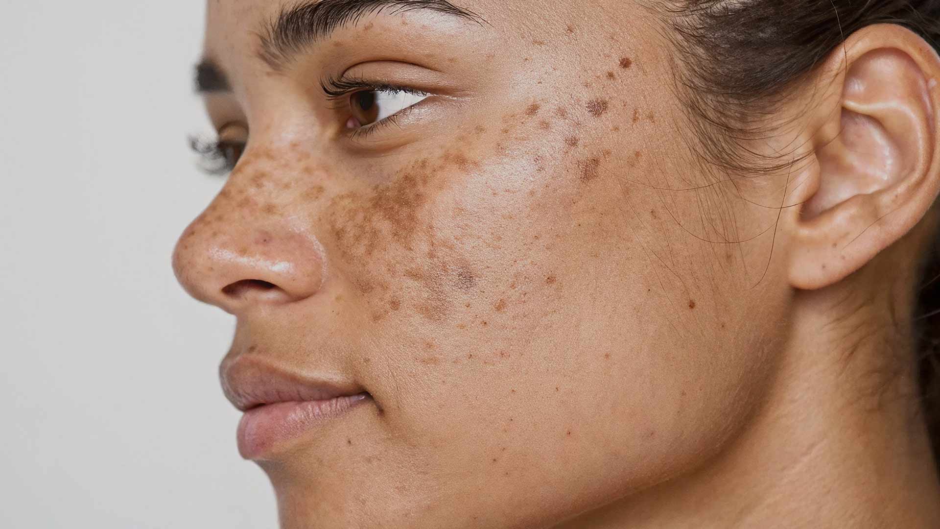 Dermapen-Hypopigmentation-Treatment-Monaz-Clinic