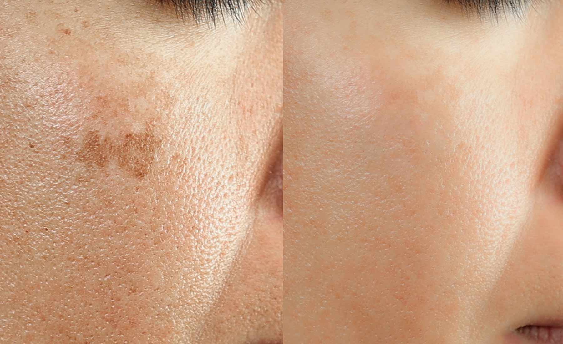 Dermapen Hypopigmentation Treatment before after 1