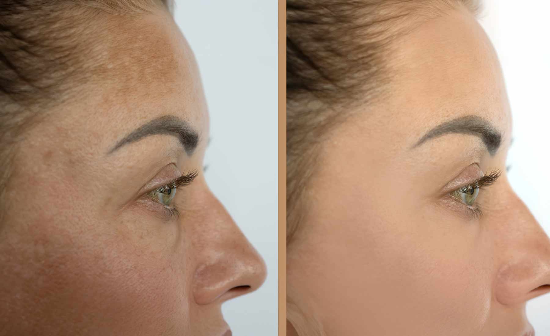 Dermapen-Hypopigmentation-Treatment-before-after-2