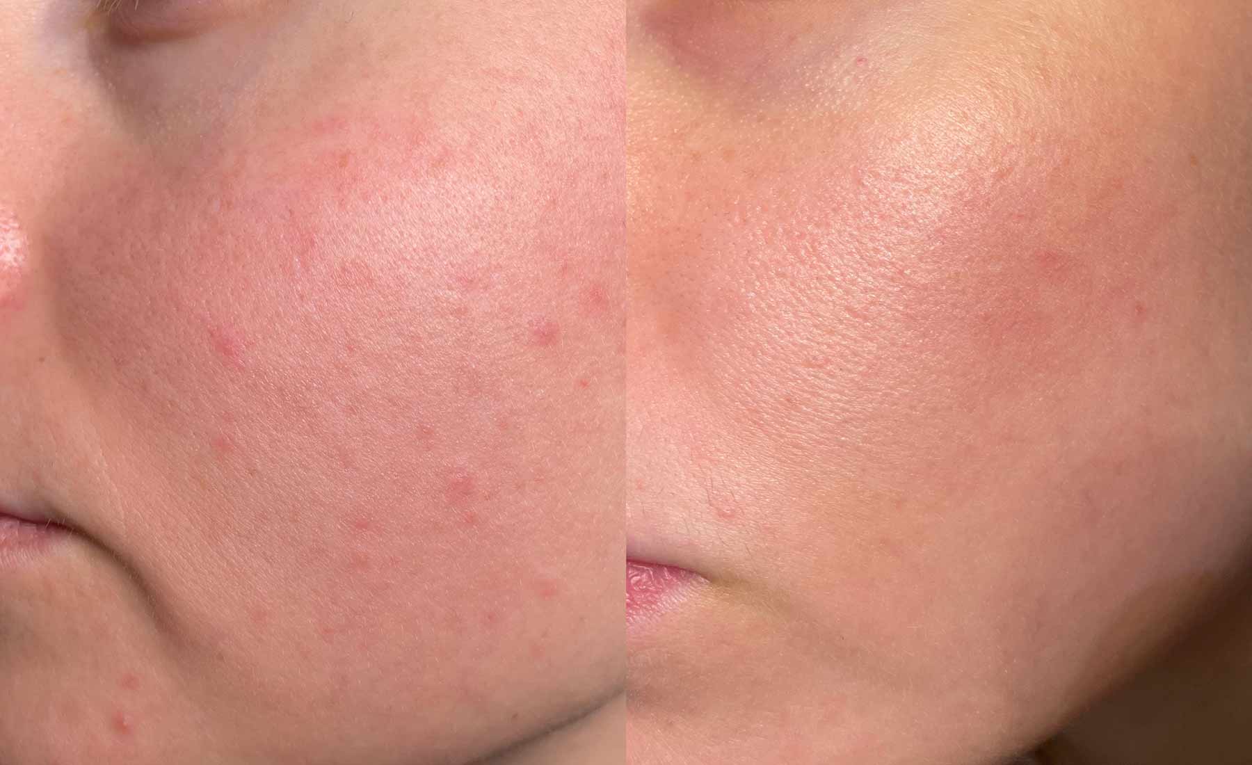 Dermapen Microneedling Before After Photo 1