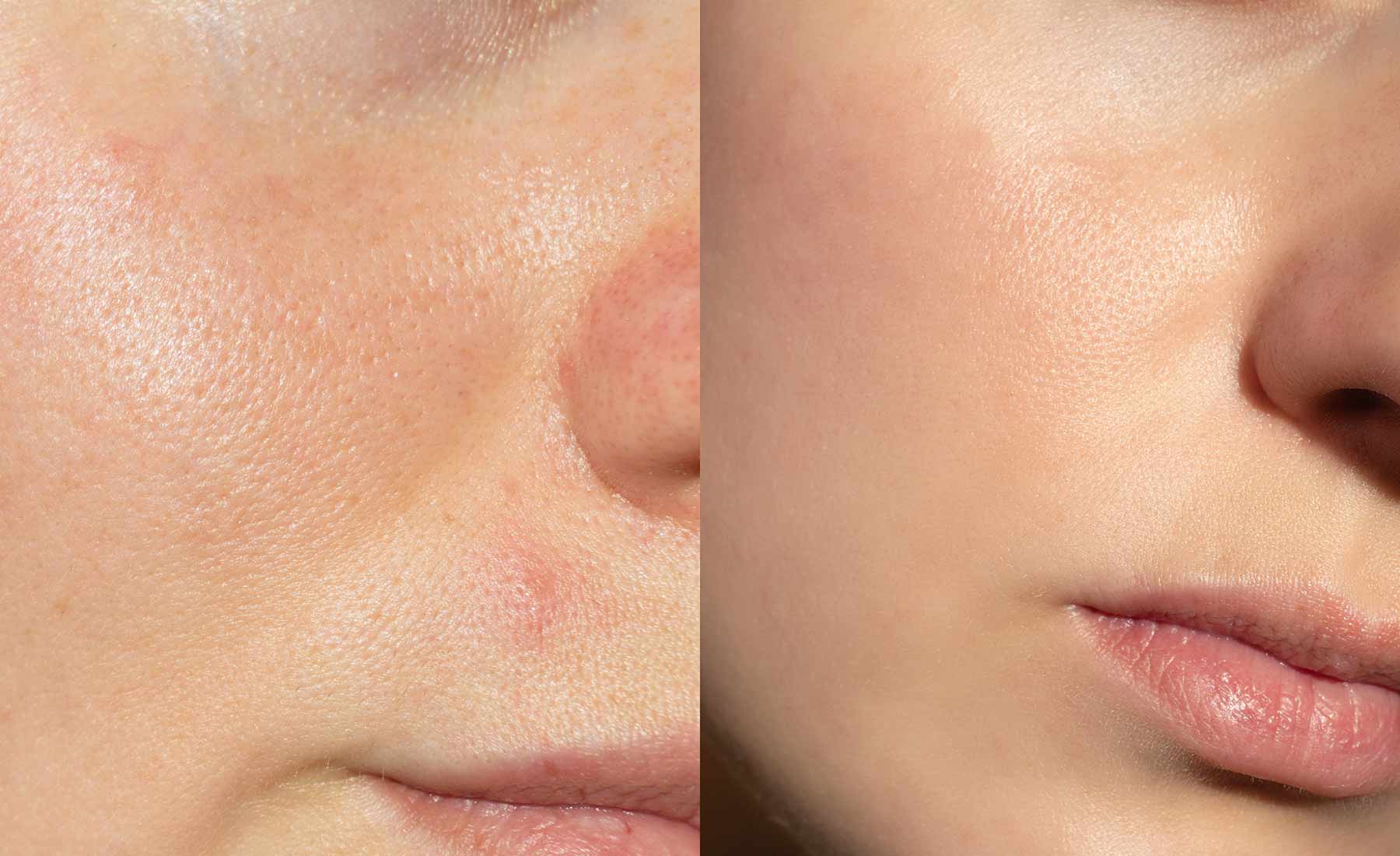 Dermapen Microneedling + Exosome 3 Dermapen Microneedling Exosome Before and after 1