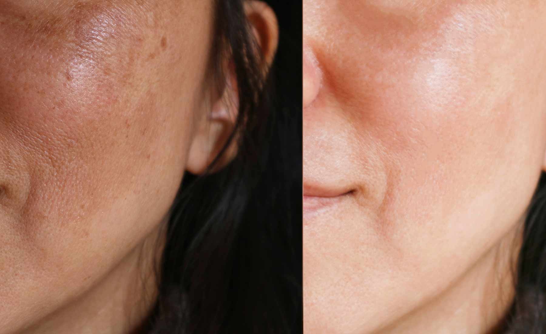 Dermapen Microneedling + Exosome 4 Dermapen Microneedling Exosome Before and after 2