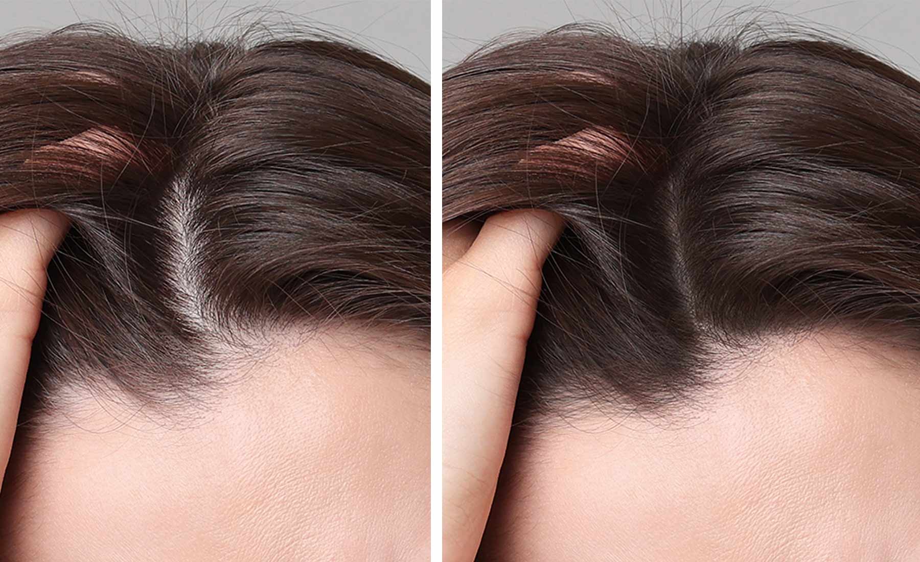 Dermapen-Microneedling-Treatment-before-and-after-2