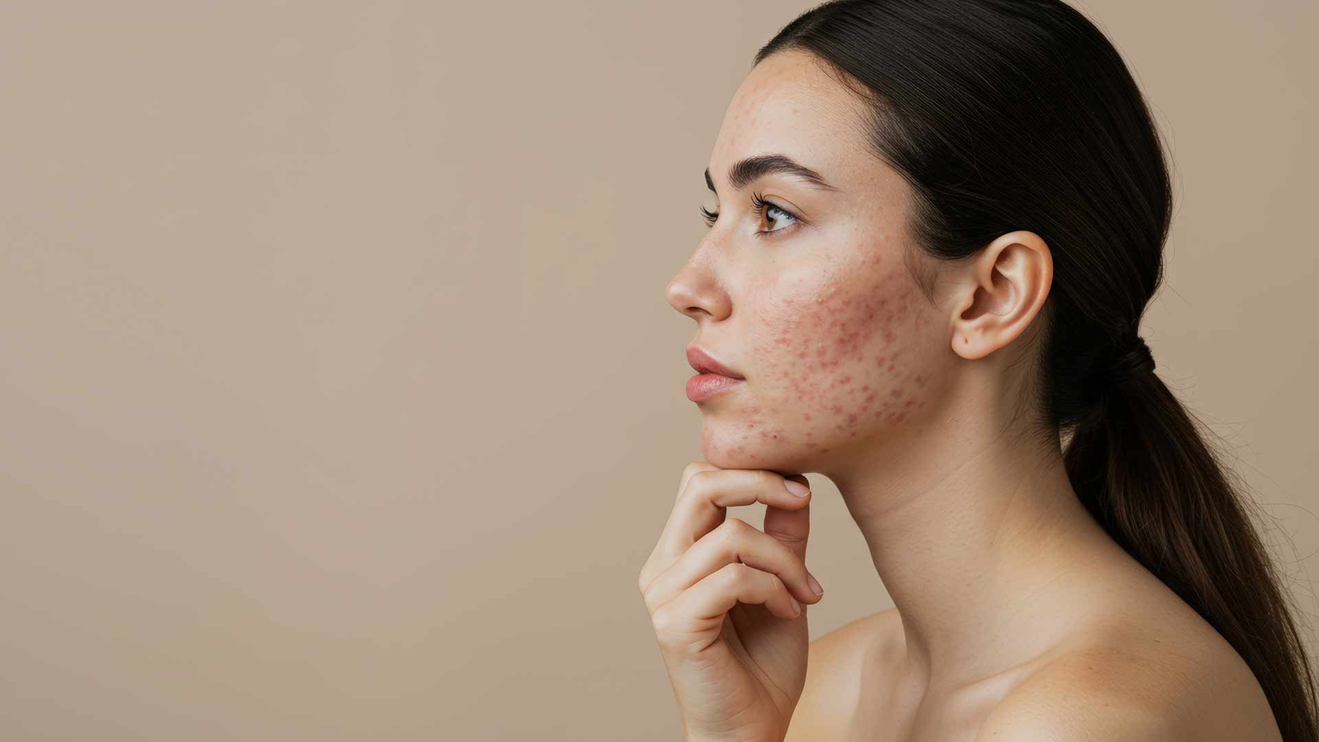 Dermapen-Microneedling-Treatment-for-Acne-and-Problematic-Skin-Monaz-Clinic