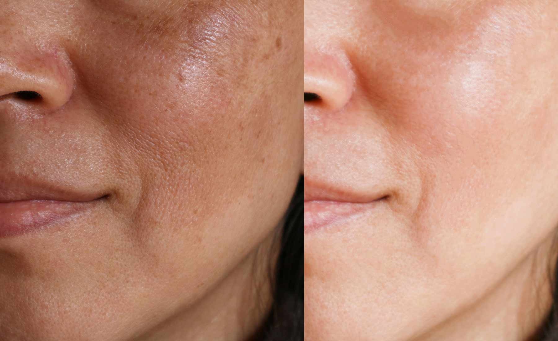 Dermapen Pigmentation Treatment before after 1
