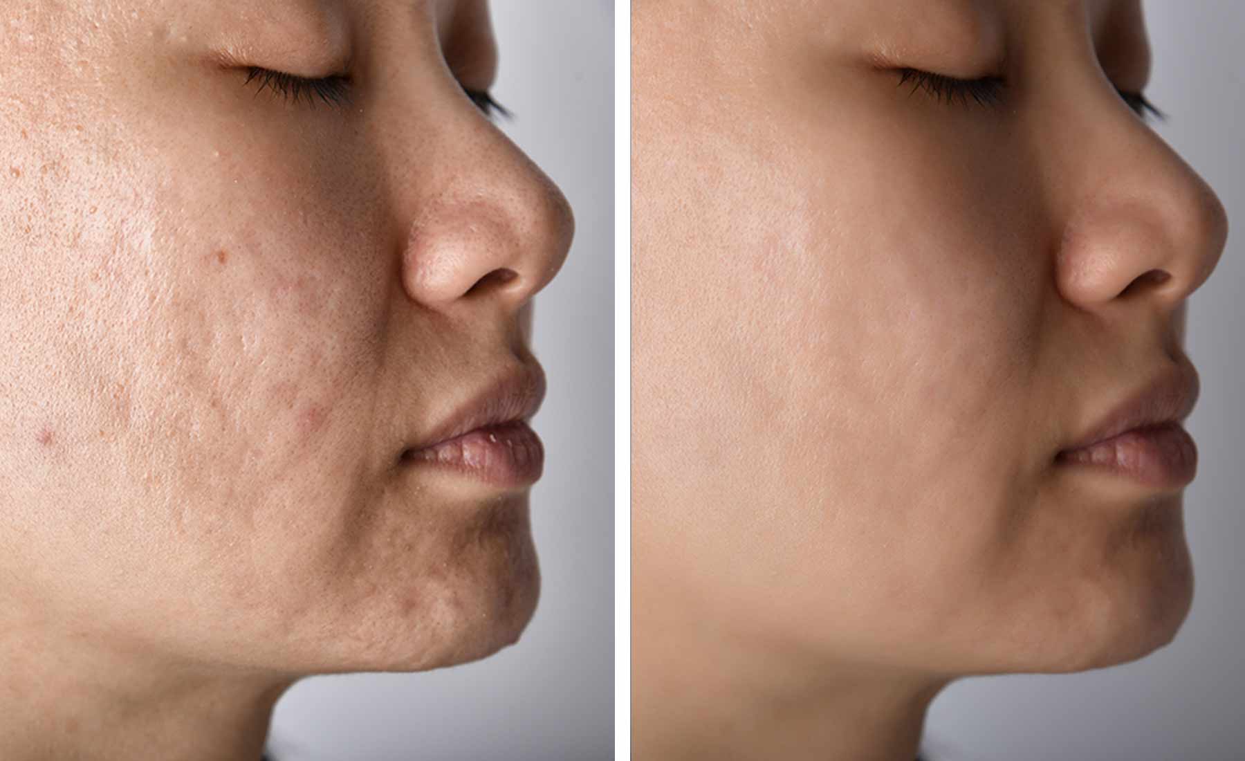 Dermapen Pigmentation Treatment before after 2 1