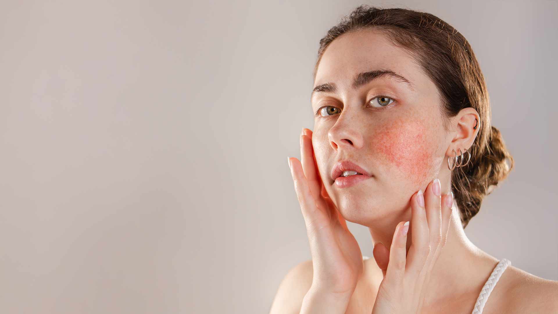 Dermapen-Rosacea-Treatment-Monaz-Clinic