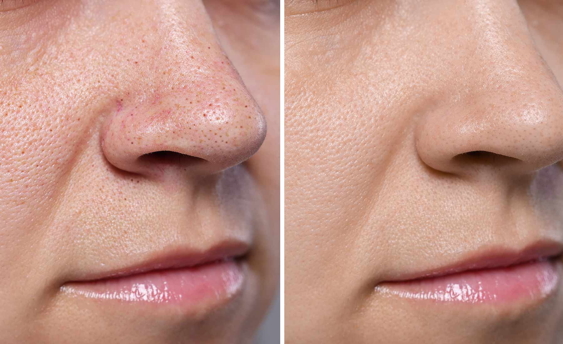 Exosomes Treatment 3 Dermapen-Skin-Rejuvenation-With-Exosomes-before-after-1