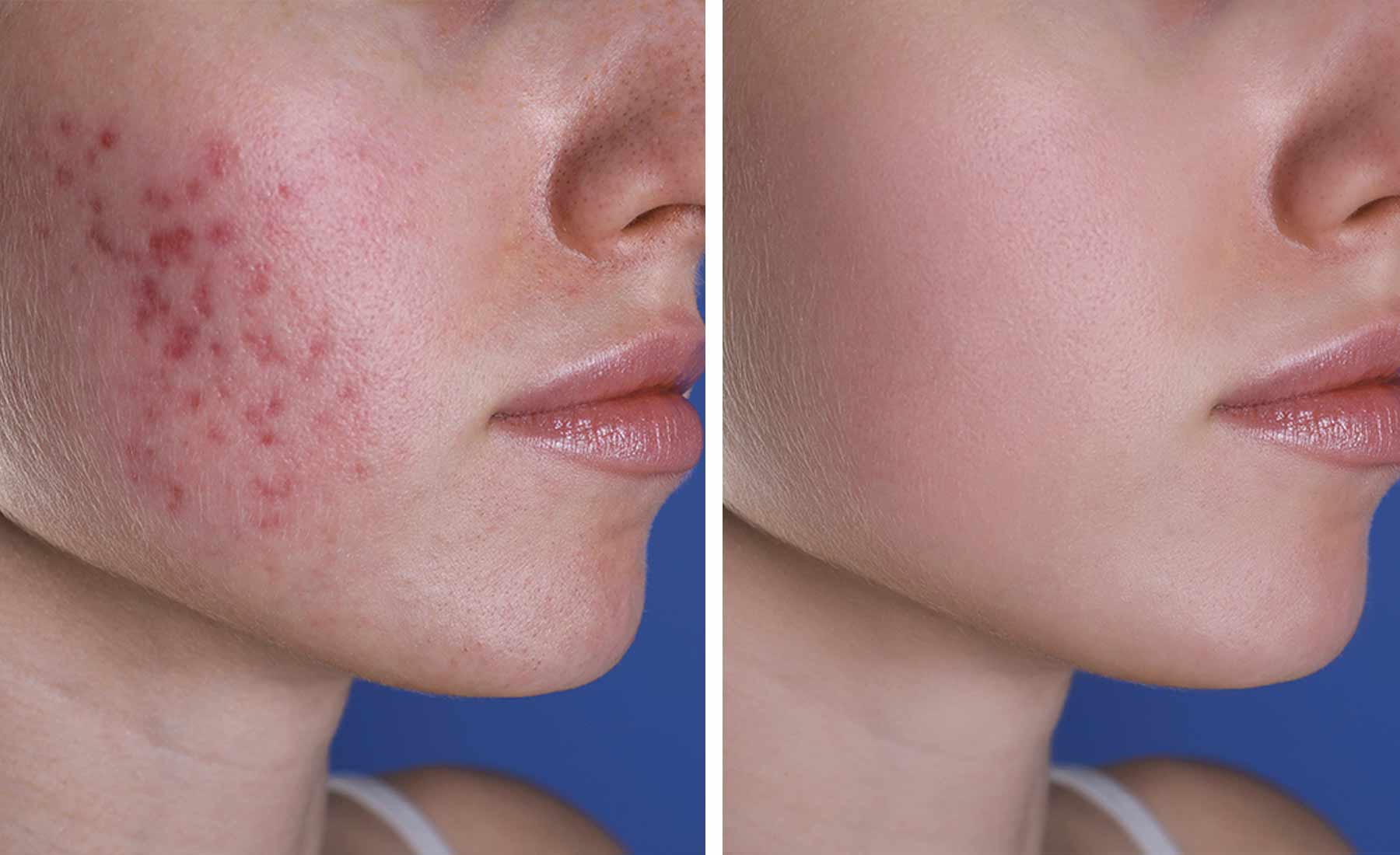 Exosomes Treatment 4 Dermapen-Skin-Rejuvenation-With-Exosomes-before-after-2