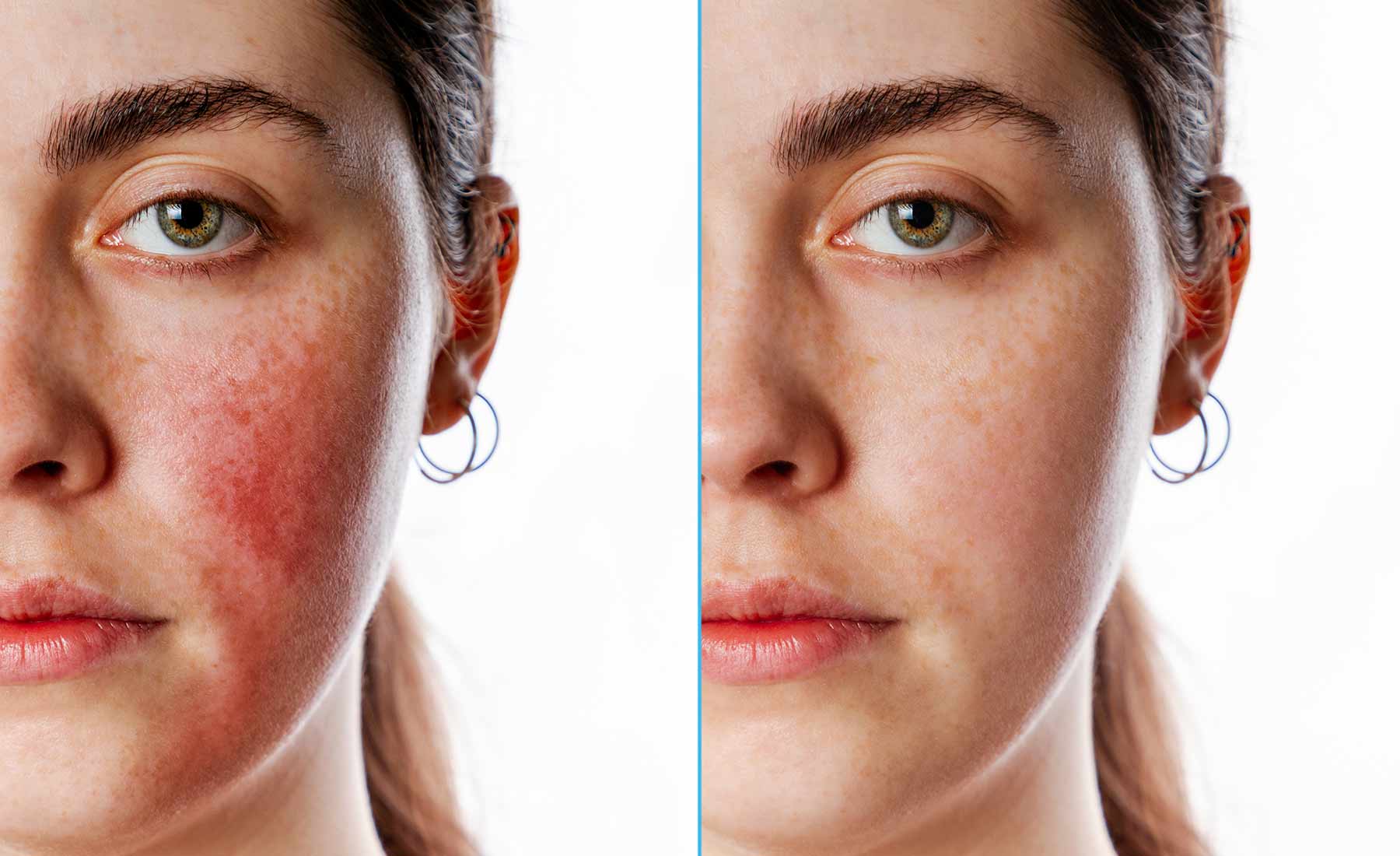 Dermapen Rosacea Treatment 3 Dermapen-for-Rosacea-before-and-after-1