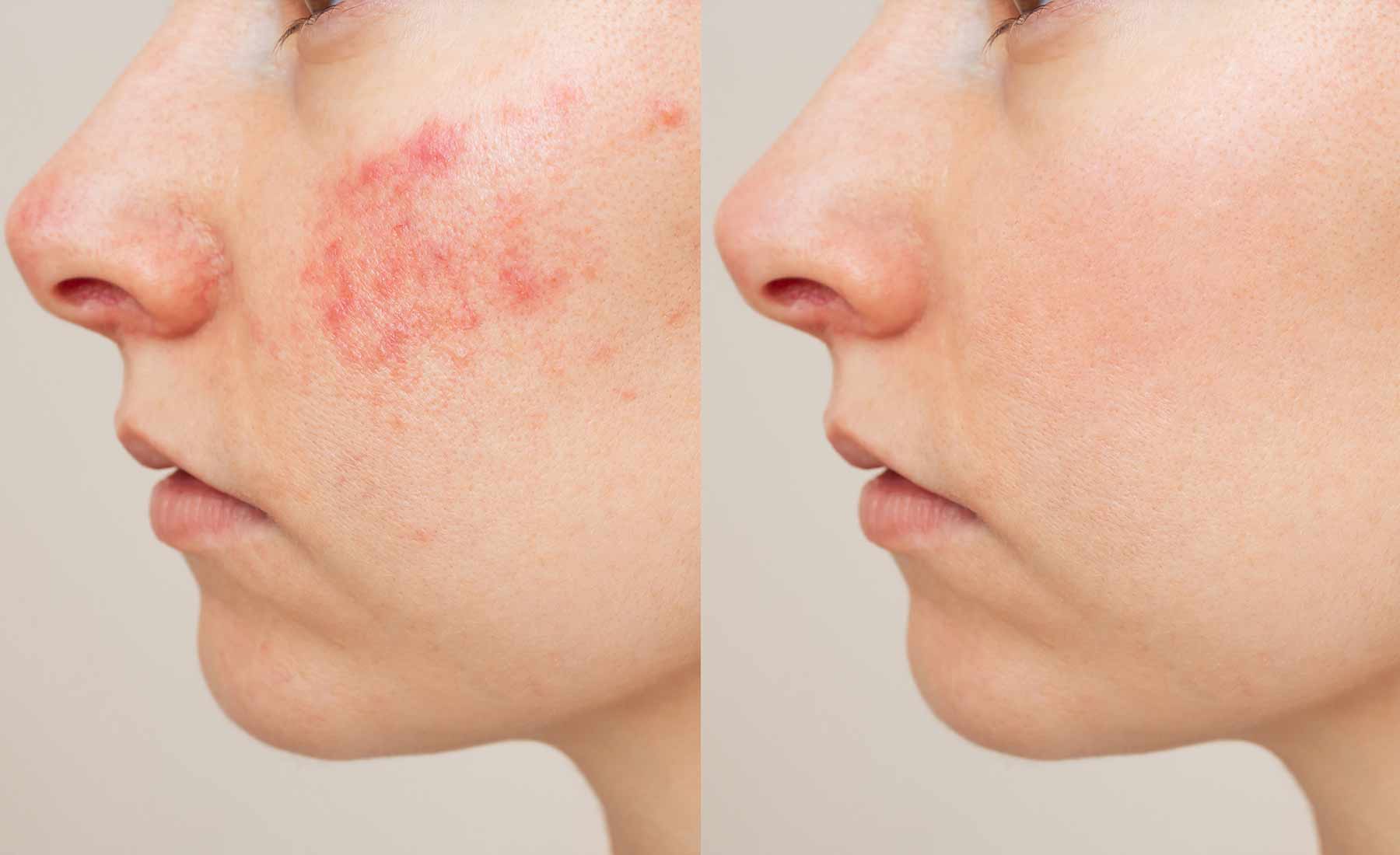 Dermapen Rosacea Treatment 4 Dermapen for Rosacea before and after 2