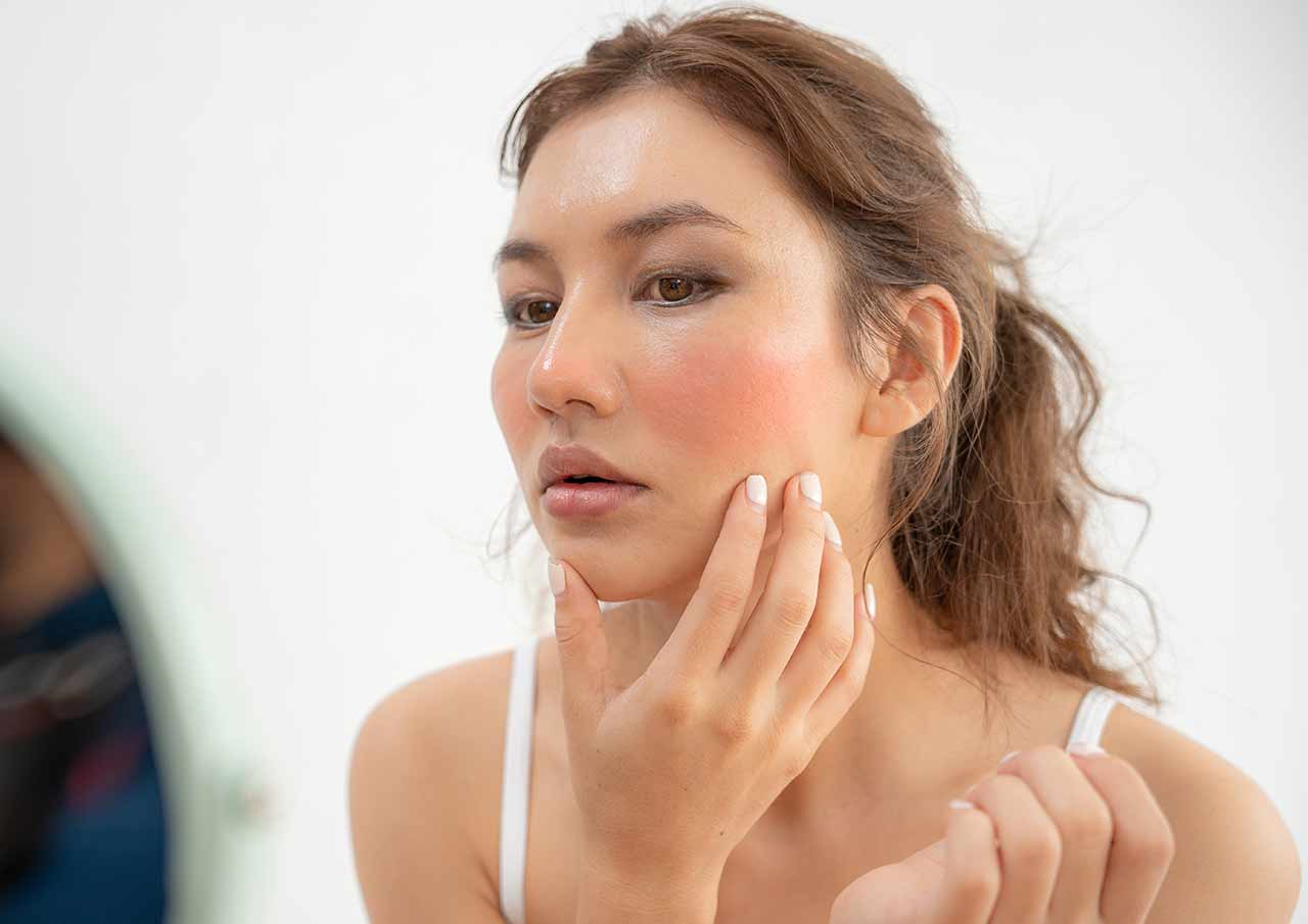 Dermapen Rosacea Treatment 1 Lokking to Reduce Rosacea Flare Ups Naturally