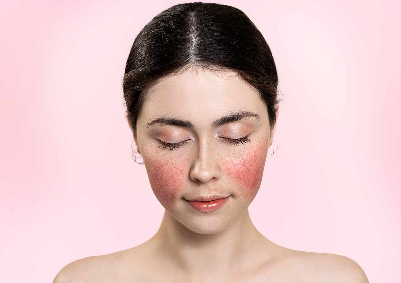 Dermapen Rosacea Treatment 2 Why-Choose-Dermapen-for-Rosacea