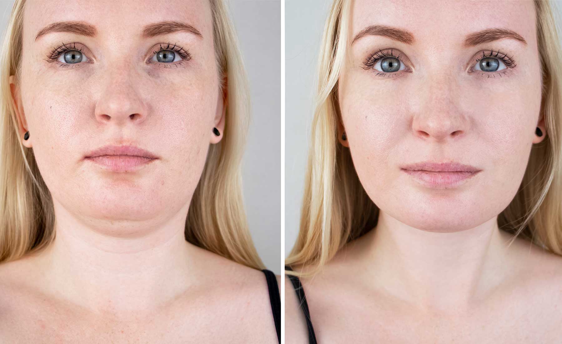 AQUALYX-Before-and-after-1