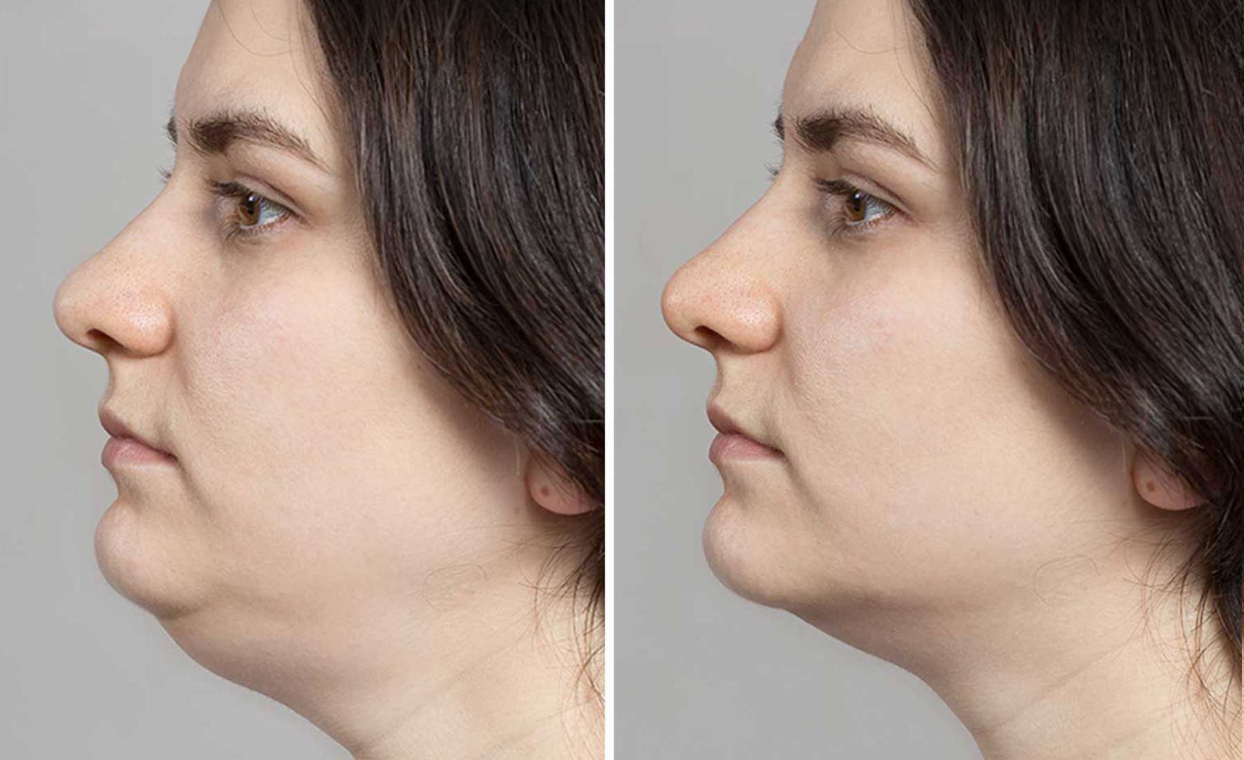 AQUALYX-Before-and-after-3