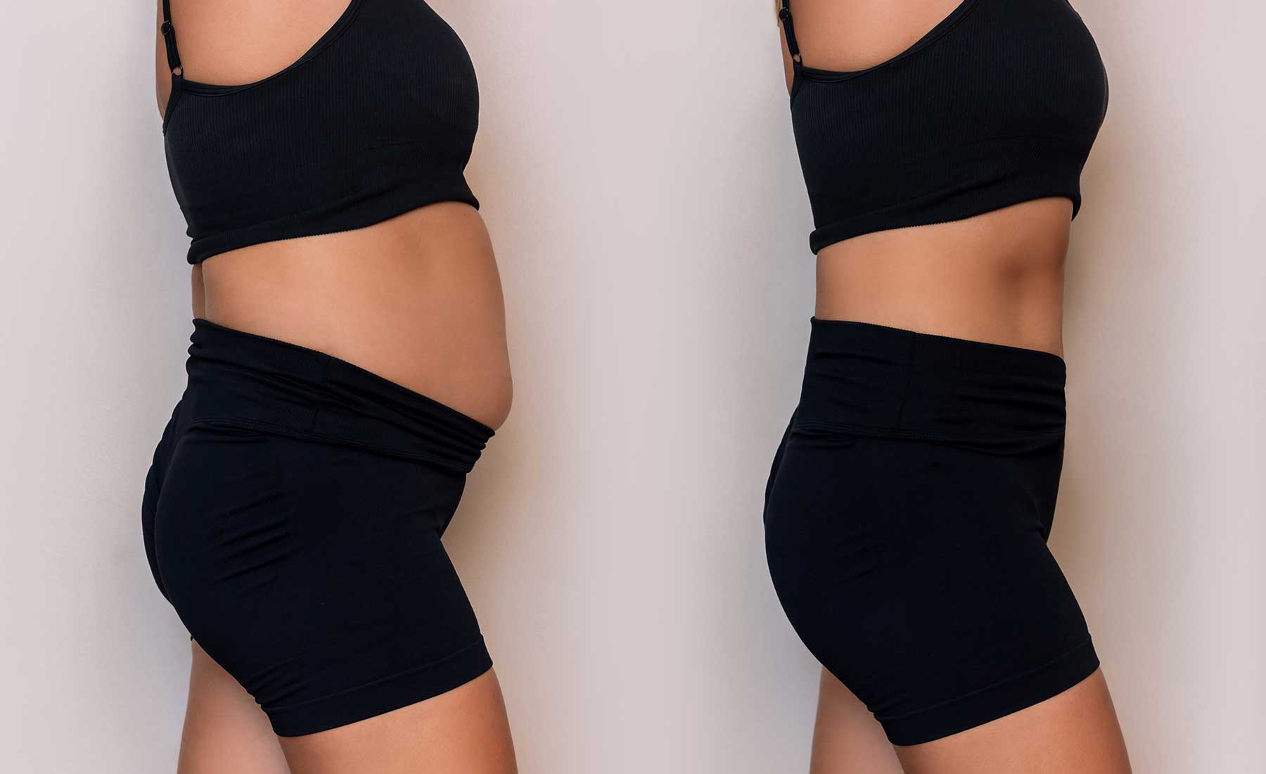 AQUALYX-fat-dissolving-before-and-after-2