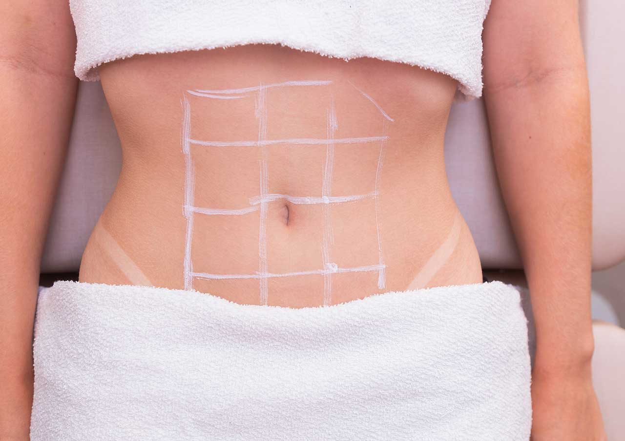 Abdomen-fat-dissolving-The-Treatment-Process-Monaz-Clinic