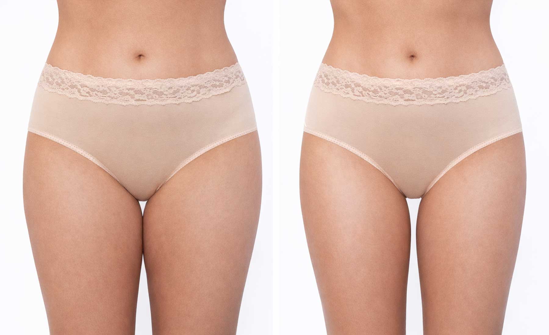 Inner-Thigh-Fat-Dissolving-before-and-after-2