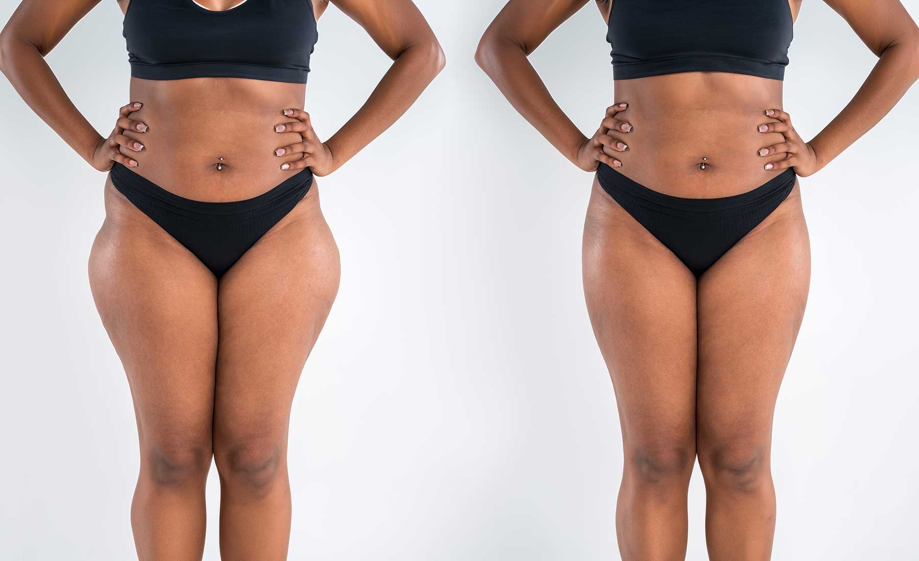 Outer Thigh Fat Dissolving with AQUALYX 4 Outer Thigh Fat Dissolving before after 2