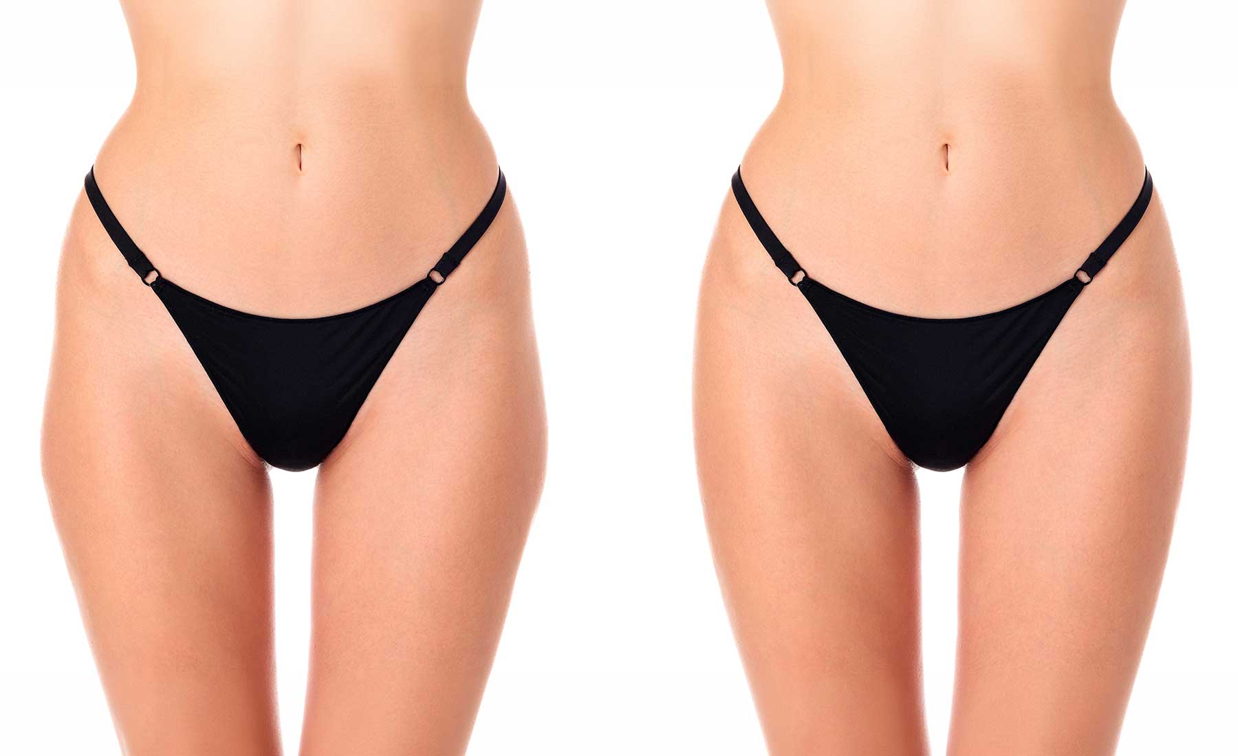 Outer Thigh Fat Dissolving with AQUALYX 3 Outer-Thigh-Fat-Dissolving-before-and-after-2