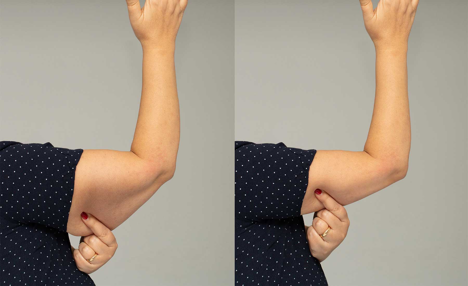 Underarm-fat-dissolving-with-aqualyx-before-and-after-1