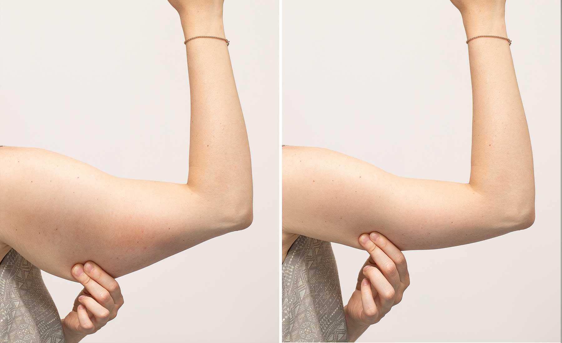 Underarm-fat-dissolving-with-aqualyx-before-and-after-2
